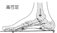 高弓足