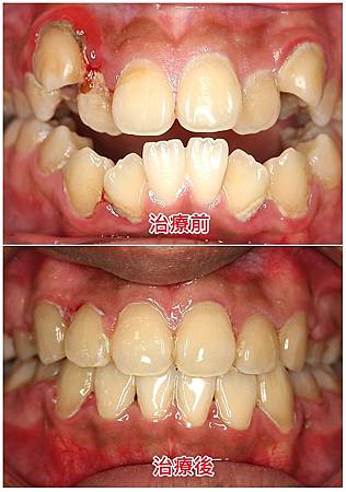 牙齒擁擠治療前後
