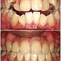 牙齒擁擠治療前後