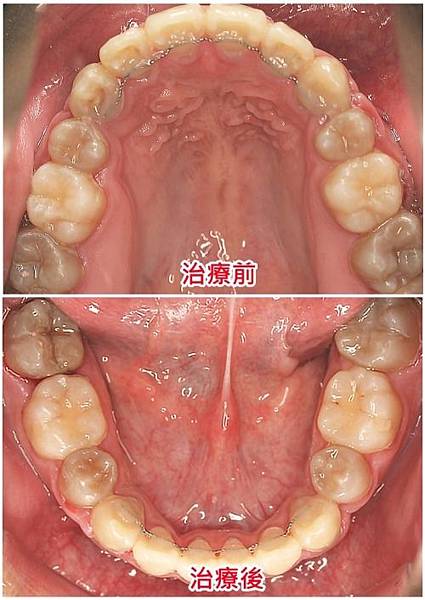 四環黴素和牙齒染色-2