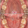 四環黴素和牙齒染色-2