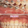 前牙錯咬的臨床治療-2