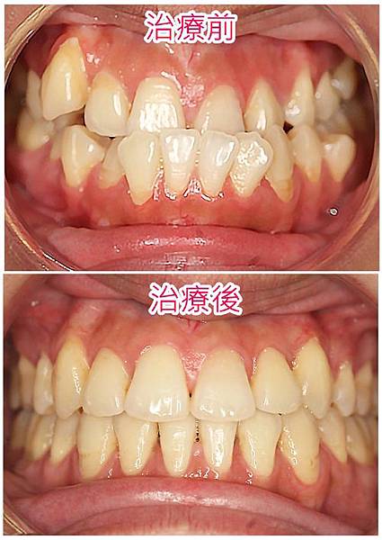 前牙錯咬合併臉型外暴-1