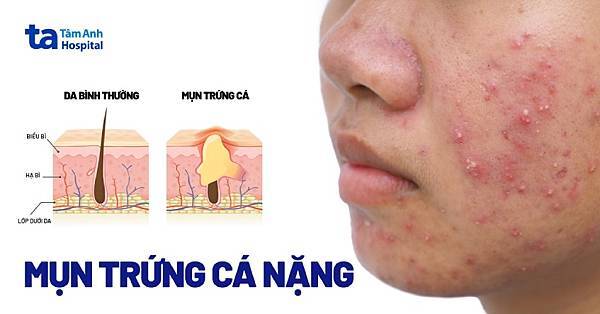Trị Mụn Trứng Cá Bằng Lá Ổi: B