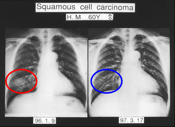 Squamous cell carcinoma 01.GIF