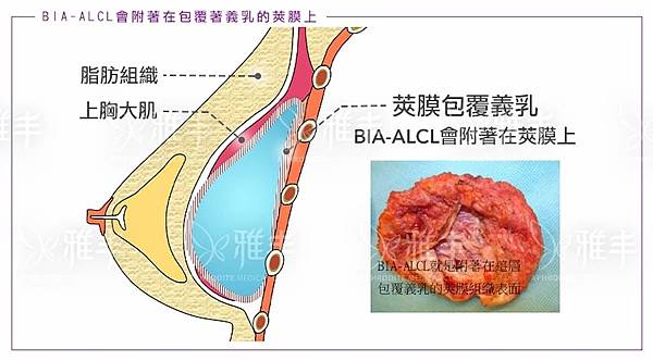 請重製，BIA-ALCL示意圖.jpg