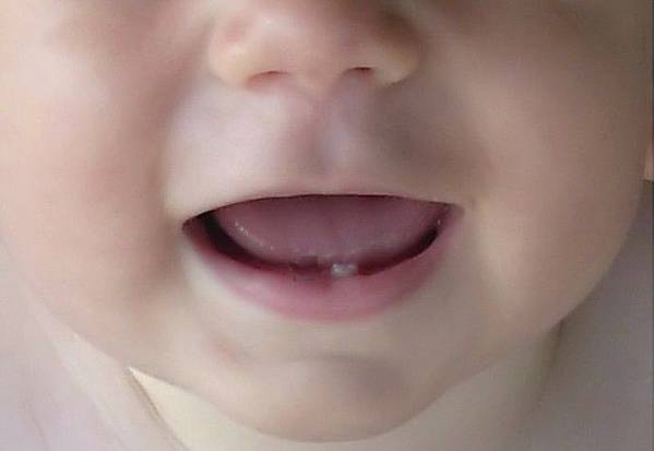 baby-first-teeth1