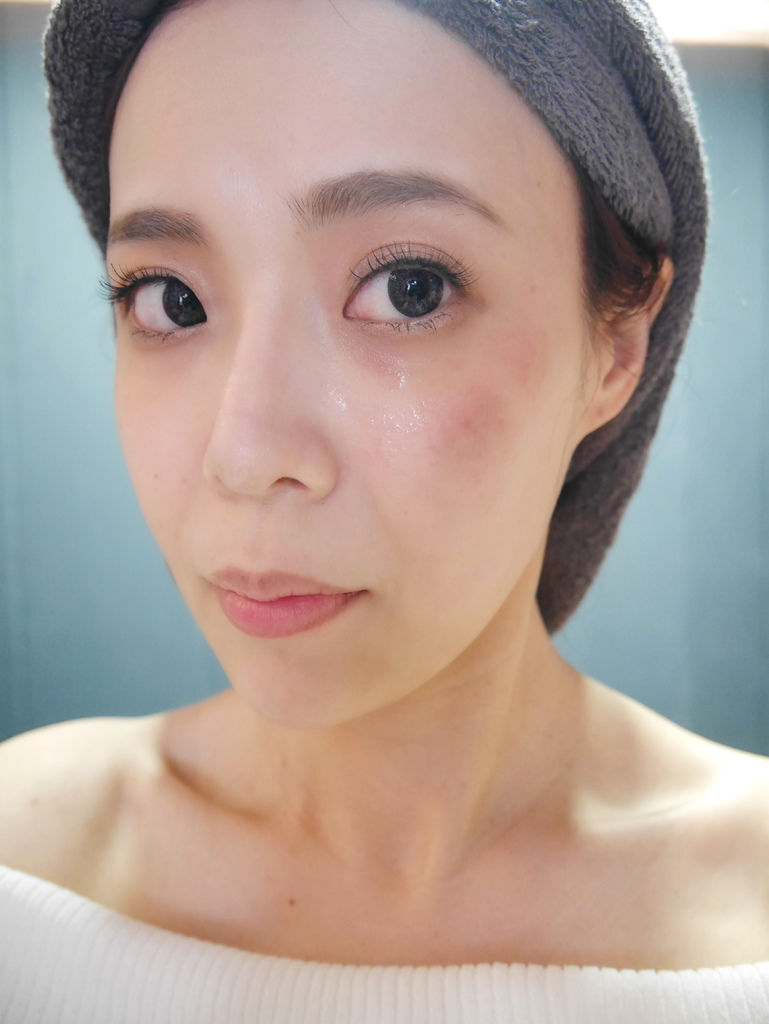 4 雷射后 左脸明显泛红.JPG