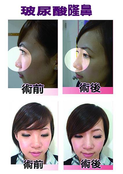 玻尿酸 abby.jpg 玻尿酸 abby.jpg