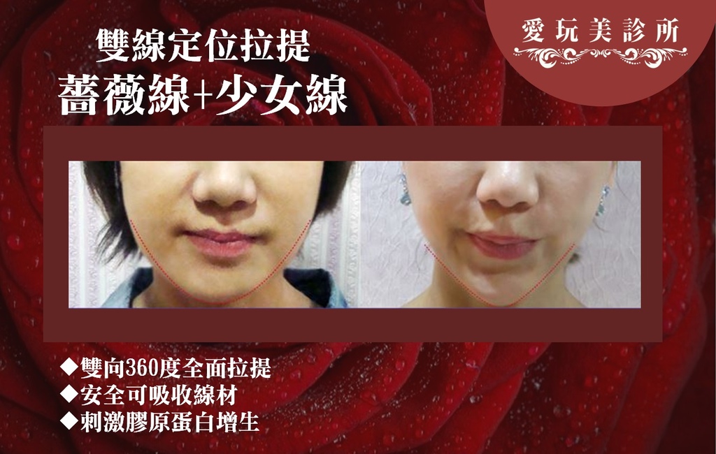 雙線定位拉提_BA.jpg 雙線定位拉提_BA.jpg