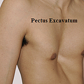 pectus_pathologie_0.png