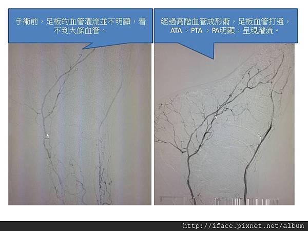 CH3 糖尿病傷口癒合處理方法：從居家門診住院照顧 糖尿病傷