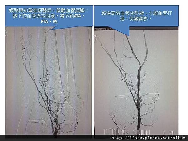 糖尿病傷口癒合處理方法：糖尿病下肢潰瘍免截肢