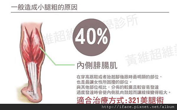 《蘿蔔腿 瘦小腿 高選擇性纖纖美腿術(神經切除+小腿抽脂)─