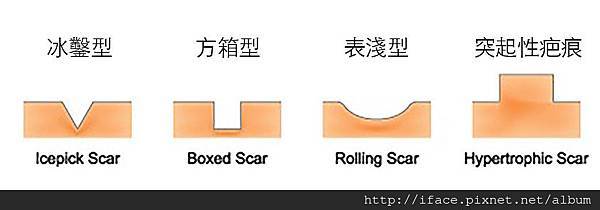 痘疤治療分類