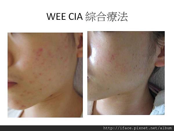 WEE青春痘與痘疤治療方案 2 WEE青春痘與痘疤治療方案 2
