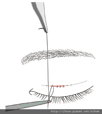 雙眼皮縫線