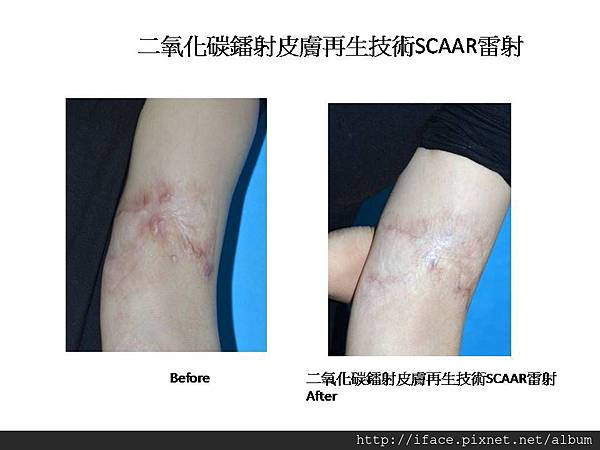 投影片5 疤痕