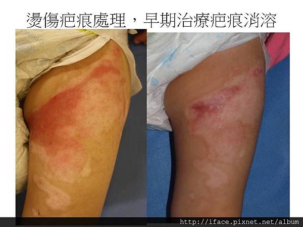投影片2 疤痕