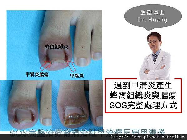 甲溝炎SOS治療 (2) 甲溝炎SOS治療 (2)