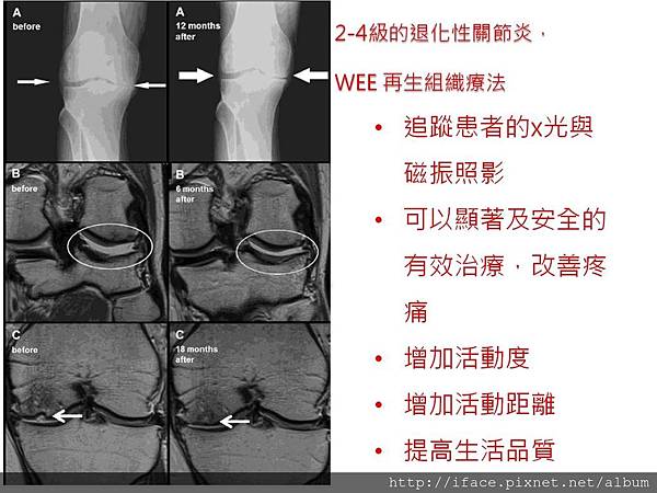 再生組織關節療法 2