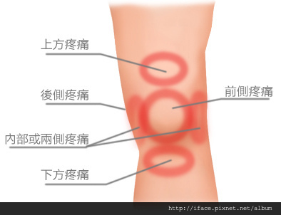 膝關節疼痛 修復膝關節與韌帶疼痛(免開刀,PRP治療失敗),