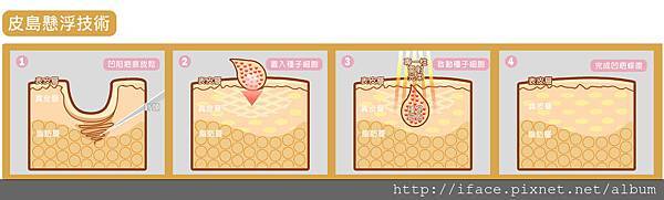 《痘凹疤修補─FB社團熱烈討論真皮移植填補》UP雷射價錢(3