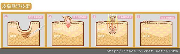 《真皮移植填補痘疤FB社團熱烈討論真皮移植填補》UP雷射價 《真皮移植填補痘疤FB社團熱烈討論真皮移植填補》UP雷射價
