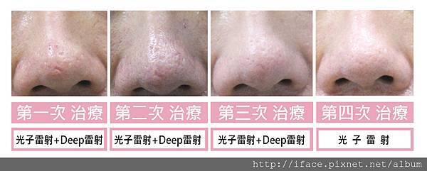 顯微穿刺 顯微穿刺