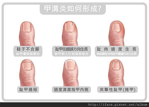 甲溝炎形成原因 甲溝炎形成原因