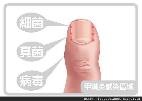 甲溝炎SOS急救原則,凍甲/崁甲/灰指甲/捲甲怎麼辦? We 甲溝炎SOS急救原則,凍甲/崁甲/灰指甲/捲甲怎麼辦? We
