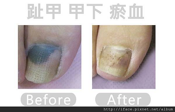 指甲下 瘀血 指甲下 瘀血