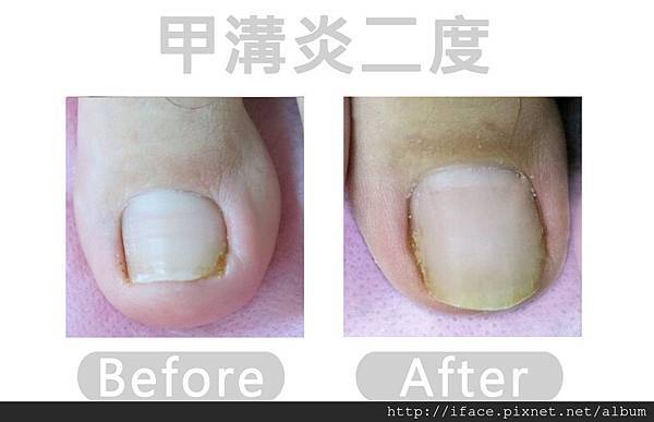 甲溝炎SOS急救原則,凍甲/崁甲/灰指甲/捲甲怎麼辦? We 甲溝炎二度