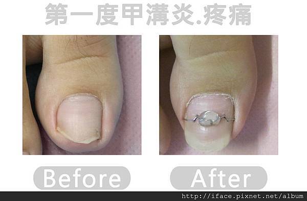甲溝炎SOS急救原則,凍甲/崁甲/灰指甲/捲甲怎麼辦? We 輕度甲溝炎