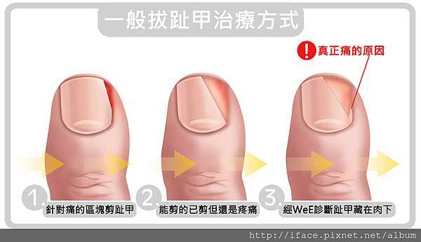 甲溝炎治療 台北 台中 新竹 甲溝炎治療