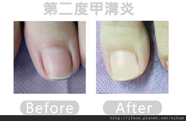 指甲矯正治療