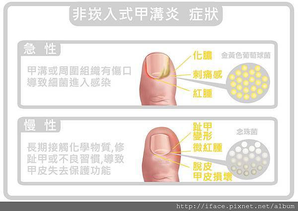 甲溝炎SOS急救原則,凍甲/崁甲/灰指甲/捲甲怎麼辦? We