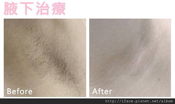 新竹/台中 『真空除毛』推薦 基尼線除毛VIO私密除毛 K