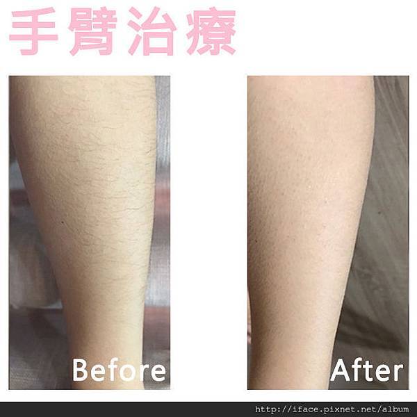 新竹/台中 『真空除毛』推薦 基尼線除毛VIO私密除毛 K