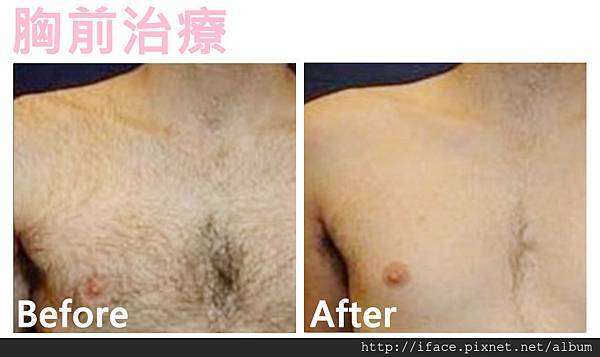 新竹/台中 『真空除毛』推薦 基尼線除毛VIO私密除毛 K 新竹/台中 『真空除毛』推薦 基尼線除毛VIO私密除毛 K