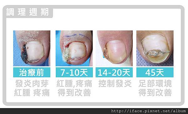 甲溝炎居家自我照顧:足部清潔 調理足部環境 根治甲溝炎