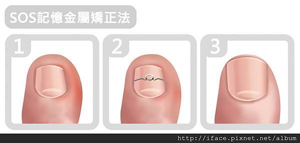 甲溝炎治療 台北 台中 新竹 甲溝炎治療 台北 台中 新竹