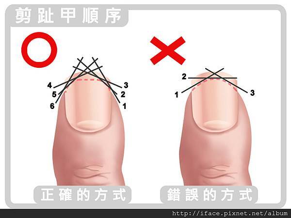 甲溝炎居家自我照顧:足部清潔 調理足部環境 根治甲溝炎