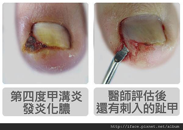 凍甲處理、凍甲矯正、矯正後復發 、發膿、肉芽處理(凍甲/嵌甲