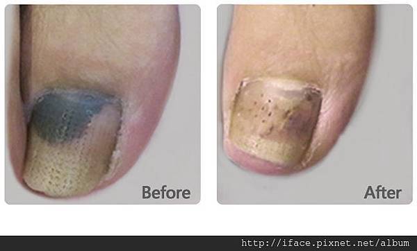 指甲瘀青 處理 指甲瘀青 處理