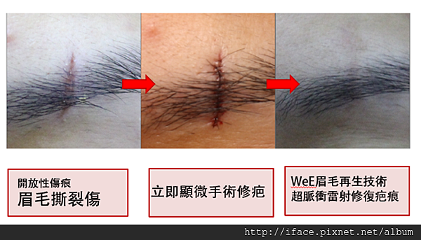 顯微手術縫合 不留疤