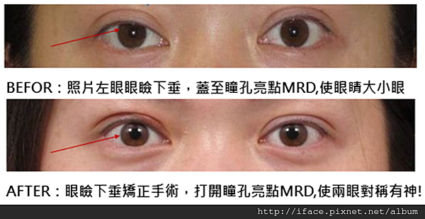 高階顯微手術 雙眼皮疤痕 重修 搶救割壞雙眼皮 眼頭疤痕 眼尾疤痕 高位雙眼皮 10大案例分析你是哪一個 法喬維美整形美容外科 台北新竹台中高雄 高階顯微手術 雙眼皮疤痕 重修 搶救割壞雙眼皮 眼頭疤痕 眼尾疤痕 高位雙眼皮 10大案例分析你是哪一個 法喬維美整形美容外科 台北新竹台中高雄