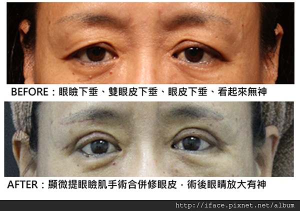 雙眼皮重修-大小眼三角眼，眼頭疤痕怎麼辦? 眼睛無神 眼瞼下