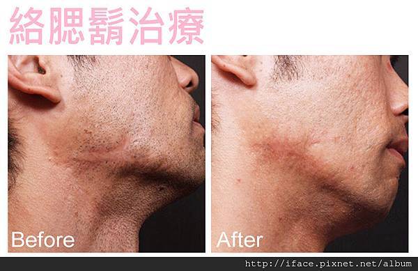 新竹/台中 『真空除毛』推薦 基尼線除毛VIO私密除毛 K 新竹/台中 『真空除毛』推薦 基尼線除毛VIO私密除毛 K