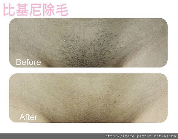 新竹/台中 『真空除毛』推薦 基尼線除毛VIO私密除毛 K 新竹/台中 『真空除毛』推薦 基尼線除毛VIO私密除毛 K